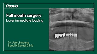 Clinical Case Full mouth surgery lower immediate loading [upl. by Schlesinger298]