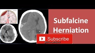 Subfalcine Herniation [upl. by Ariaj]