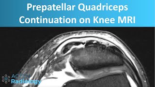 Prepatellar Quadriceps Continuation on Knee MRI  Anatomy and Pathology [upl. by Endaira]