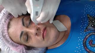 Aula de revitalização facial com plasma de ozônio [upl. by Airdnek]