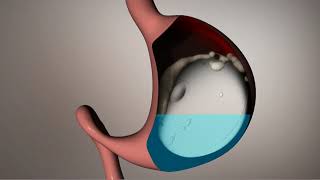 The Allurion Swallowable Gastric Balloon  How it works [upl. by Lliw68]