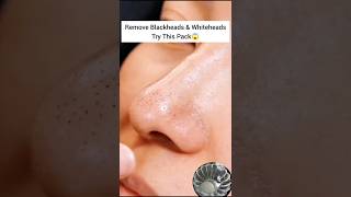 🔥Remove Open Pores Treatment Naturally😱 Best Home Remedy ✅ shorts youtubeshorts skincare [upl. by Nonez648]