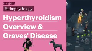 Hyperthyroidism Overview amp Graves Disease Internal Medicine  Sketchy Medical [upl. by Jessen642]