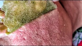 Blackhead Removal Using Mask in AsiaBlackheads Removal [upl. by Adair]