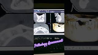 Akshaywat Scancbct3dscan 3dimages3dprinting3dillustration3danimation3dvisualizationpathology [upl. by Lunt851]