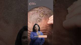 Scalp Psoriasis Treatment  Skin Doctor in Ludhiana  Dr Shikha Aggarwal [upl. by Goody]