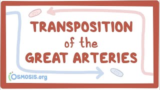 Transposition of the great arteries TGA  causes symptoms treatment amp pathology [upl. by Horgan]