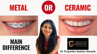 WHAT IS DIFFERENCE BETWEEN METAL AND CERAMIC BRACES  COMPARISON BETWEEN METAL AND CERAMIC BRACES [upl. by Funch476]