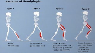 Gait patterns in Children with hemiplegic cerebral Palsy [upl. by Caplan]