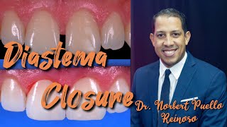 Diastema closure Composite restoration front teeth Dr Norbert Puello Reinoso [upl. by Anitnuahs]