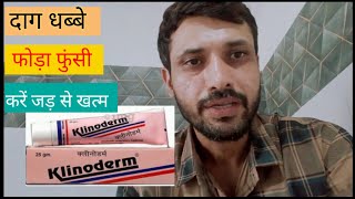 दाग धब्बे फोड़े फुंसियों के लिए आयुर्वेदिक इलाज klinoderm cream review [upl. by Drwde205]