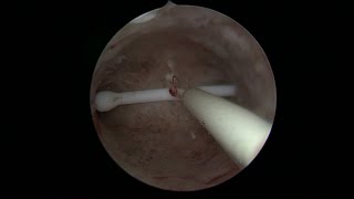 Le retrait dun stérilet  hystéroscopie  Dr Ahmed SKHIRI  Hysteroscopic removal of IUD [upl. by Enialb]