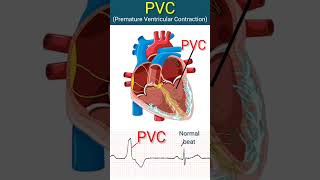 Heart with PVCs l heart ecg shorts [upl. by Nosnek]