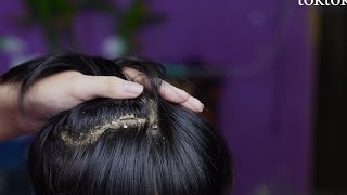 dandruff removal huge flakes scratching on head15 [upl. by Bass442]