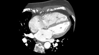 Atrial Septal Defect [upl. by Jenks]