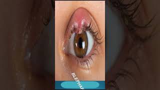 Blepharitis Treatment  Which Medicine Use In Blepharitis [upl. by Sivert684]