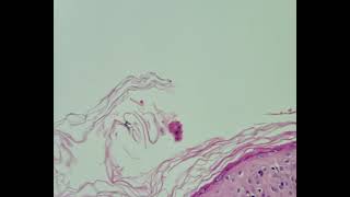 Histopathology of Lupus erythematosus [upl. by Gnaoh]