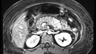 Acute Pancreatitis [upl. by Leggett826]