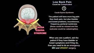 Understanding Complicated Low Back Pain Causes Symptoms and Treatment Options [upl. by Savior]