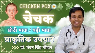 Chicken Pox Treatment  बड़ी माता  छोटी माता  चेचक का प्राकृतिक उपचार  Dr Chandan Singh [upl. by Lambrecht616]