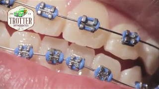 Watch How Braces Are Put On  Orthodontic Treatment Using Fixed Brackets Redondo Beach Orthodontist [upl. by Eerat721]