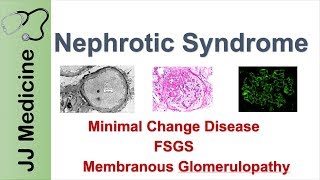 Nephrotic Syndrome  Clinical Presentation Causes and Treatment [upl. by Enoek]