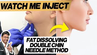 Fat Dissolving Injections For Double Chin Needle HowTo [upl. by Avruch]