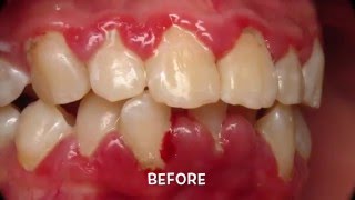 Treatment of Periodontal Gum Disease [upl. by Otreblon352]