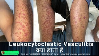 Leukocytoclastic Vasculitis  sudden red rashes  red spot on leg palpable purpura Dr Uttam Lenka [upl. by Arammahs455]