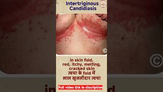 candidiasis  fungal skin infection  oral thrush shorts reels [upl. by Beltran]