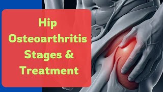 Understanding Hip Osteoarthritis Stages and Treatments Explained [upl. by Ailices]