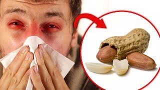 Peanut allergy treatment  The TRUTH About Peanuts Revealed Why They Are Bad [upl. by Louanne]