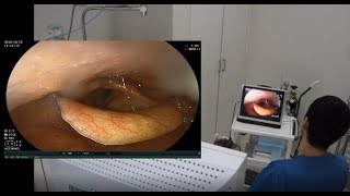 専門医による胃カメラ検査 Trans nasal Endoscopy doitmyself [upl. by Loutitia755]