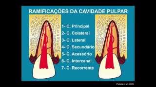 Abertura Coronária e Preparo do Canal Radicular [upl. by Colombi]