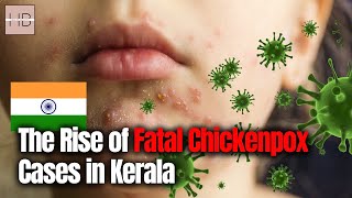 Breaking News Chickenpox Outbreak Claims Lives in Kerala India  What You Need to Know [upl. by Aonehc96]