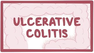 Ulcerative colitis  causes symptoms diagnosis treatment pathology [upl. by Ebba]