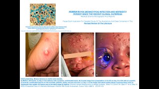 HUMAN M pox Monkeypox Infection And Morbidity Persist Since The Recent Global Outbreak [upl. by Itida]