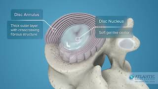 What is Cervical Degenerative Disc Disease AtlanticSpineCenter [upl. by Suilmann]