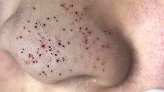 Big Cystic Acne Blackheads Extraction Blackheads amp Milia Whiteheads Removal Pimple Popping  1239 [upl. by Iren]