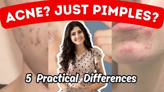 Acne VS Pimples Top 5 Differences  How to Tell What Your Breakouts Mean [upl. by Otrevire621]