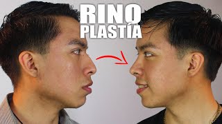 Cambió su rostro con la RINOSEPTOPLASTÍA 👃🏼 RINOPLASTÍA estética funcional ❤️ Dr PERCY NEVADO ALBÁN [upl. by Shea197]