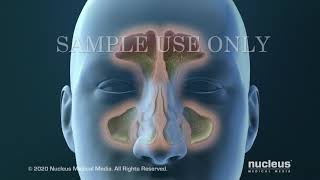 Sinusitis Surgery [upl. by Ruhtra]