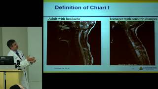 quotAnswers to Common Questions About Chiari Malformationquot  Eric Jackson MD [upl. by Ferd]