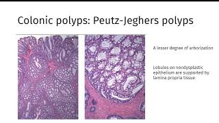 GI polyps GIPATH [upl. by Siusan]