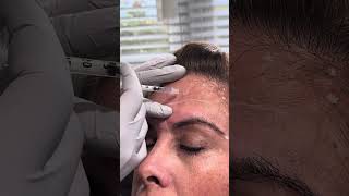 Botox for the forehead [upl. by Aima]