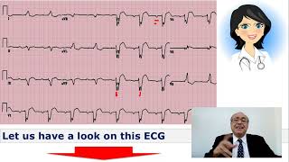 EKG Trainer Case 3 Answer [upl. by O'Kelly]