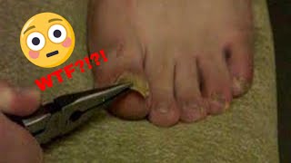 TheToe  Ingrown toenail being ripped off by pliers [upl. by Anelyak]