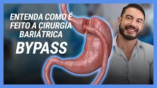 Entenda como é feito a Cirurgia Bariátrica BYPASS  Dr Leonardo Fiuza [upl. by Borden]