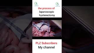 the process of laparoscopic hysterectomy laparoscopicsurgery hysterectomy foryou bomb fypシ [upl. by Yseulta]