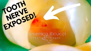 Tooth Cavity  Partial Pulpotomy 2 Healed Without a Root Canal  Dr Ricucci [upl. by Nosyerg]